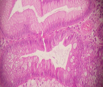 erradicacion_helicobacter_pylori/inflamacion_mucosa_gastrica erradicacion_helicobacter_pylori/inflamacion_mucosa_gastrica