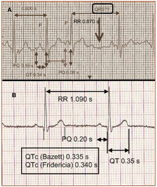 bloqueo_auriculo_ventricular/PQ_QT_RR_intervalo