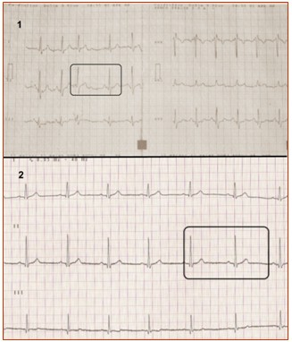 bloqueo_auriculo_ventricular/segundo_grado_no_mobitz