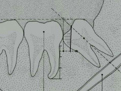 segundo_tercer_molar_impactado/odontoseccion_exeresis