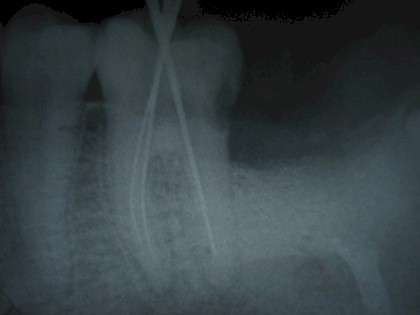 segundo_tercer_molar_impactado/tratamiento_pulporradicular