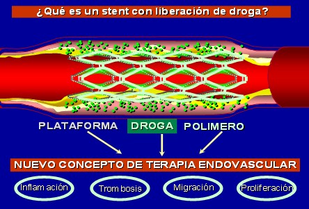 stents_liberadores_drogas/actp_liberacion_farmacos stents_liberadores_drogas/actp_liberacion_farmacos