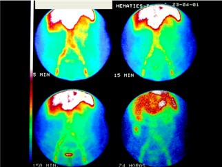 angiodisplasia_colon_estenosis_aortica/gammagrafia_hemorragia_digestiva_angiodisplasia