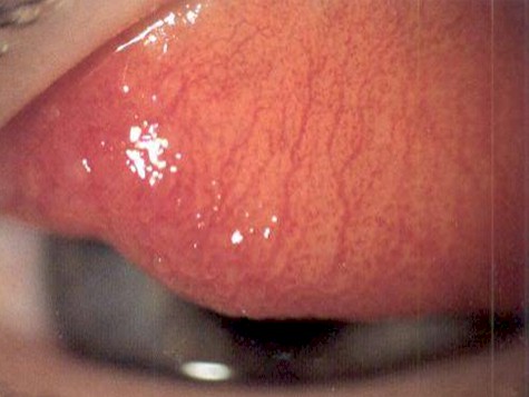 conjuntivitis_infecciosas/conjuntivitis_infecciosa_viral_palpebral conjuntivitis_infecciosas/conjuntivitis_infecciosa_viral_palpebral