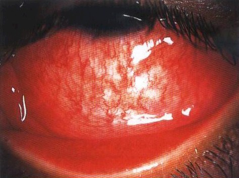 conjuntivitis_infecciosas/conjuntivitis_infecciosa_viral_virus conjuntivitis_infecciosas/conjuntivitis_infecciosa_viral_virus
