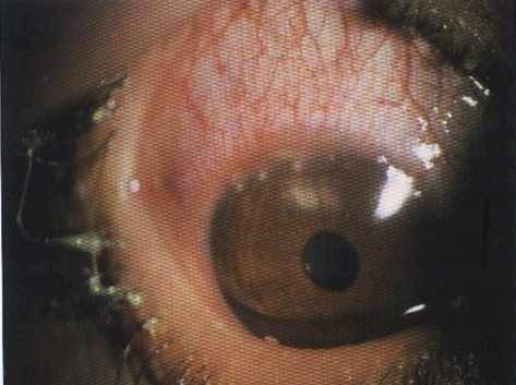 conjuntivitis_infecciosas/infiltrados_marginales_cornea_queratoconjuntivitis_chlamydias