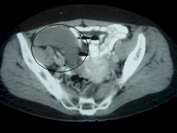 tumoracion_apendicular/mucocele_TAC_apendice_grande