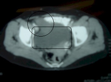 tumoracion_apendicular/mucocele_TAC_apendice_vejiga tumoracion_apendicular/mucocele_TAC_apendice_vejiga