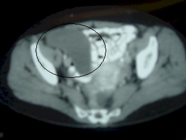 tumoracion_apendicular/mucocele_TAC_apendice_vermiforme tumoracion_apendicular/mucocele_TAC_apendice_vermiforme