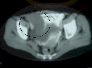 tumoracion_apendicular/mucocele_TAC_apendice_vermiforme_2 tumoracion_apendicular/mucocele_TAC_apendice_vermiforme_2