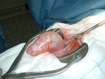 tumoracion_apendicular/mucocele_cirugia_apendice_grande