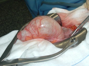 tumoracion_apendicular/mucocele_cirugia_apendice_grande_2