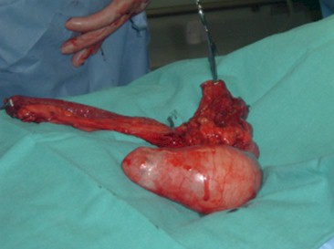 tumoracion_apendicular/mucocele_reseccion_intestino_delgado_colon