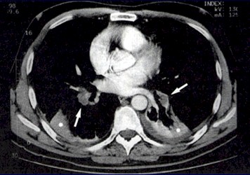 TEP_tromboembolismo_pulmonar/TAC_dilatacion_arterias_pulmonares