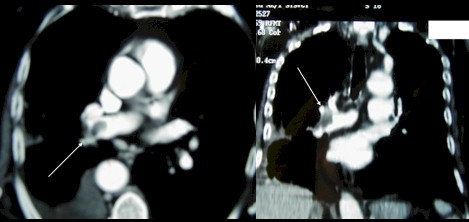 TEP_tromboembolismo_pulmonar/angiotomografia