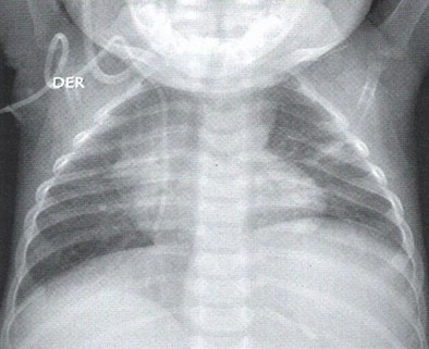 TEP_tromboembolismo_pulmonar/atelectasia_radiografia_TEP TEP_tromboembolismo_pulmonar/atelectasia_radiografia_TEP