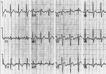 TEP_tromboembolismo_pulmonar/ecg_electrocardiograma_s1q3t3 TEP_tromboembolismo_pulmonar/ecg_electrocardiograma_s1q3t3