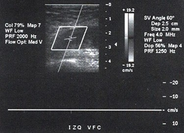 TEP_tromboembolismo_pulmonar/ecografia_trombo_femoral_trombosis TEP_tromboembolismo_pulmonar/ecografia_trombo_femoral_trombosis