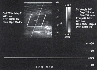 TEP_tromboembolismo_pulmonar/ecografia_trombo_femoral_trombosis