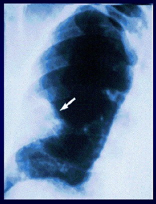 TEP_tromboembolismo_pulmonar/radiografia_simple_torax