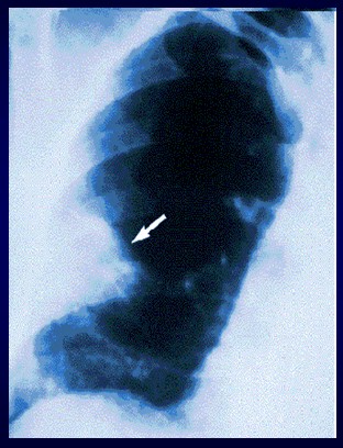TEP_tromboembolismo_pulmonar/radiografia_simple_torax TEP_tromboembolismo_pulmonar/radiografia_simple_torax