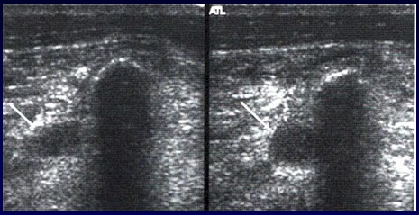 TEP_tromboembolismo_pulmonar/trombosis_venosa_miembros_inferiores