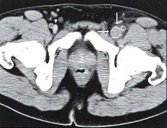 TEP_tromboembolismo_pulmonar/venografia_TC_trombosis_femoral