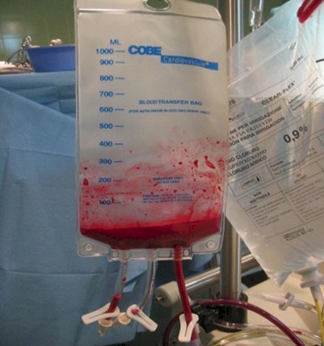 autotransfusion_recuperacion_sangre/bolsa_reinfusion_alta_velocidad