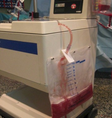 autotransfusion_recuperacion_sangre/cell_saver_bolsa_desechos_alta_velocidad