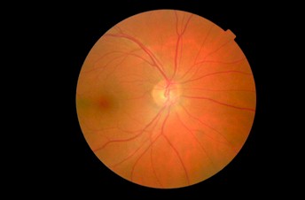 deteccion_precoz_retinopatia_diabetica/retinografia_central_retina