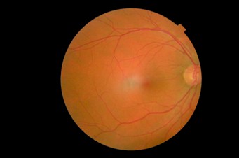 deteccion_precoz_retinopatia_diabetica/retinografia_nasal_retina