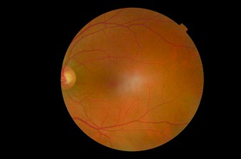 deteccion_precoz_retinopatia_diabetica/retinografia_temporal_retina