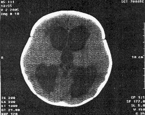diagnostico_precoz_hidrocefalia/tomografia_computerizada_TAC_TC