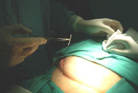 dispositivo_intrauterino_abdominal/DIU_extraccion_quirugica_cirugia dispositivo_intrauterino_abdominal/DIU_extraccion_quirugica_cirugia