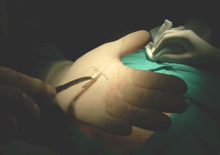 dispositivo_intrauterino_abdominal/DIU_extraccion_quirugica_quirofano dispositivo_intrauterino_abdominal/DIU_extraccion_quirugica_quirofano
