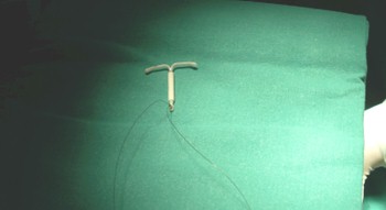 dispositivo_intrauterino_abdominal/DIU_perforacion_utero dispositivo_intrauterino_abdominal/DIU_perforacion_utero