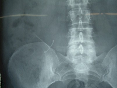 dispositivo_intrauterino_abdominal/DIU_rx_radiografia_extrauterino