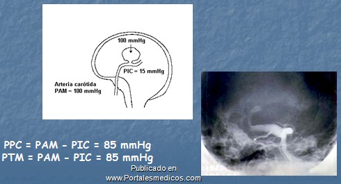 manejo_anestesico_cirugia_aneurisma/causas_rotura_aneurisma_intracraneal