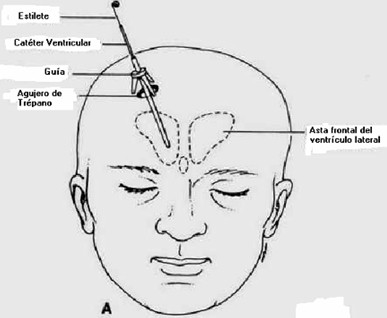 manejo_anestesico_cirugia_aneurisma/craneostato