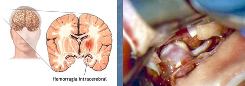 manejo_anestesico_cirugia_aneurisma/epidemiologia_aneurisma_intracraneal