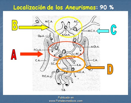 manejo_anestesico_cirugia_aneurisma/localizacion_aneurismas_cerebrales
