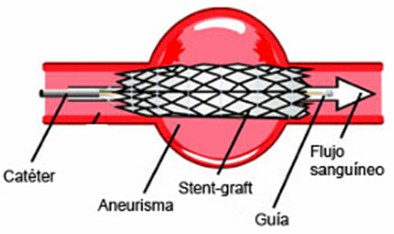 manejo_anestesico_cirugia_aneurisma/protesis_endovascular_aneurismas