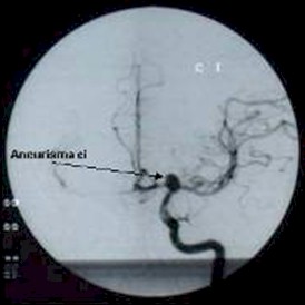 manejo_anestesico_cirugia_aneurisma/tratamiento_endovascular_aneurisma_intracraneal