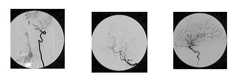 manejo_anestesico_cirugia_aneurisma/vasoespasmo_arterias_cerebrales manejo_anestesico_cirugia_aneurisma/vasoespasmo_arterias_cerebrales
