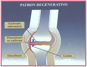 pautas_medicina_interna/osteoartrosis_patron_degenerativo