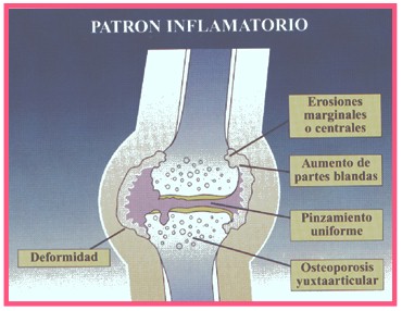 pautas_medicina_interna/osteoartrosis_patron_inflamatorio