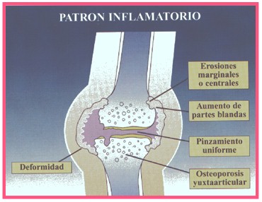 pautas_medicina_interna/osteoartrosis_patron_inflamatorio pautas_medicina_interna/osteoartrosis_patron_inflamatorio
