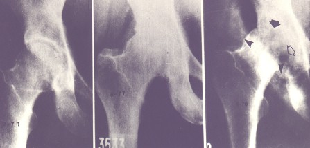 pautas_medicina_interna/osteoartrosis_radiografia_coxartrosis_evolucion