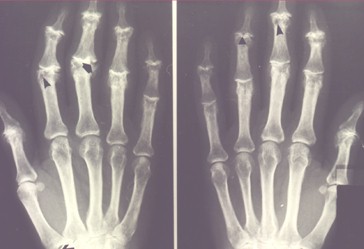 pautas_medicina_interna/osteoartrosis_radiografia_manos_signo_gaviota