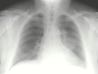 sindrome_constitucional_pancitopenia_b12/condensacion_lobulo_superior_izquierdo_radiografia